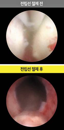 아쿠아블레이션으로 비대해진 전립선(위쪽)을 절제해 요도가 넓어진 모습./리드헬스케어 제공