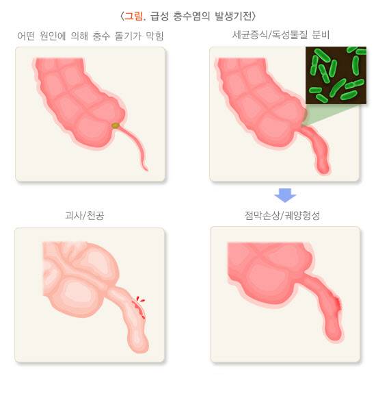 급성 충수염 발생기전(자료=질병관리청 국가건강정보포털)