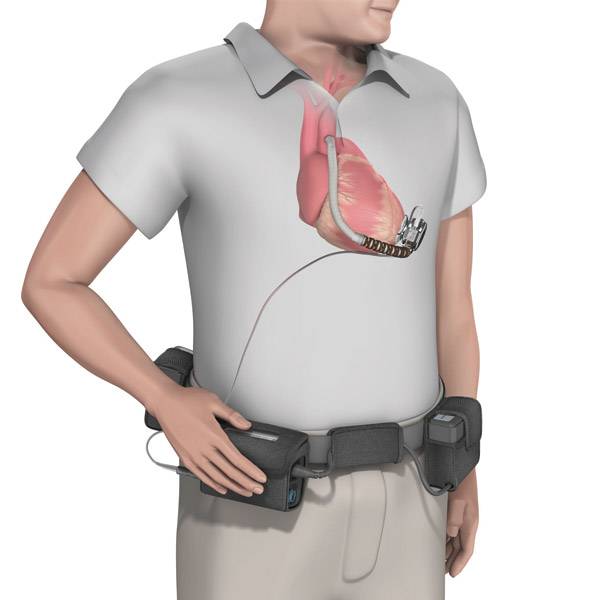 좌심실보조장치(LVAD) 수술을 받은 환자의 모습을 나타낸 그래픽 이미지. 한림대동탄성심병원 제공.
