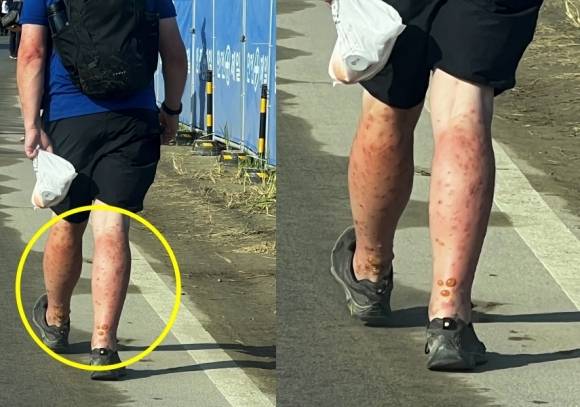 2023 새만금 세계스카우트잼버리에서 부스를 운영하는 한 외국인 참가자는 5일 연합뉴스에 잼버리 내부 상황을 알린다며 몇 장의 사진을 보내왔다. 사진은 행사장에서 창궐한 벌레 떼에 물린 한 참가자의 다리. 영국과 미국 참가단의 철수 배경에는 이러한 열악한 환경도 한몫한 것으로 알려졌다. 2023.8.5 연합뉴스(독자 제공)