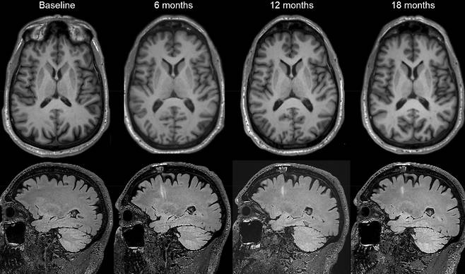 파킨슨병 환자에게 배아 줄기세포로 만든 도파민 신경전구세포를 투여했다. 18개월을 추적 관찰한 결과 별다른 부작용이 발생하지 않았다. /네이처