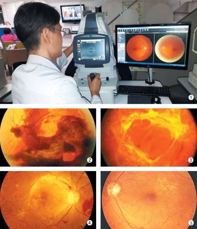 ①의사가 환자의 '안저검사'를 진행하고 있다. 실명까지 일으킬 수 있는 당뇨망막병증은 안저검사로 진단할 수 있다. ②안저검사로 확인된 증식당뇨망막병증출혈 ③증식당뇨망막병증견인망막박리 ④증식당뇨망막병증 ⑤비증식당뇨망막병증. /게티이미지뱅크·대한안과의사회 제공
