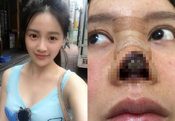 성형수술 전 가오 류 사진과 수술 부작용이 나타난 사진/사진=데일리메일, BBC