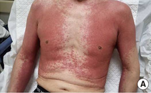 데노수맙 투약 후 몸에 대칭적으로 피부 발진이 일어난 남성 사진/사진=대한천식알레르기학회지