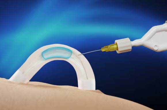 '아담' 시술 이미지./사진=콘트랄린 홈페이지 캡처