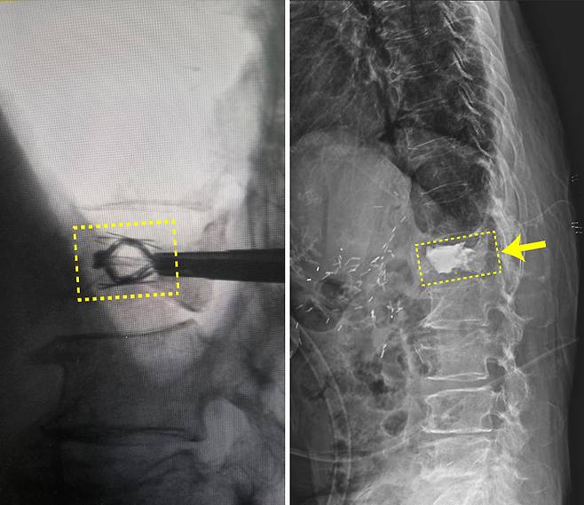 임플란트를 삽입해 압박 골절된 척추체를 들어 올린 모습(왼쪽)과 골시멘트가 채워진 모습(오른쪽). 인천힘찬종합병원 제공