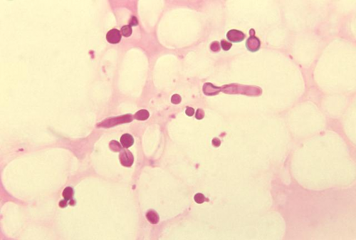 피부염을 앓고 있는 환자에서 포착된 말라세지아 곰팡이. 출처: CDC