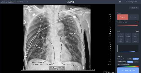 뷰노 VUNO Med-Chest X-ray 사용 이미지./사진=뷰노