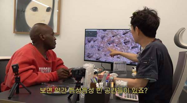 두피 검사 결과, 조나단의 탈모가 상당히 진행됐고 모발 사이 빈 공간이 많이 생긴 것으로 확인됐다./사진=유튜브 채널 ‘조나단’