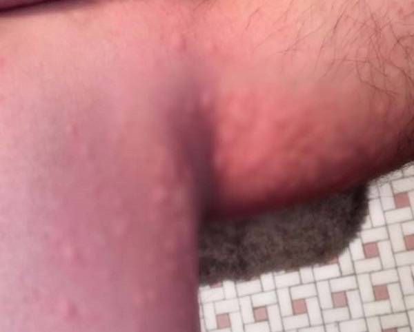 건강을 위해 하는 운동도 때론 독이 되는 경우가 있다. 실제로 운동만 하면 몸에 알레르기 증상을 겪는 20대 남성의 사례가 공개됐다./사진=큐레우스 저널