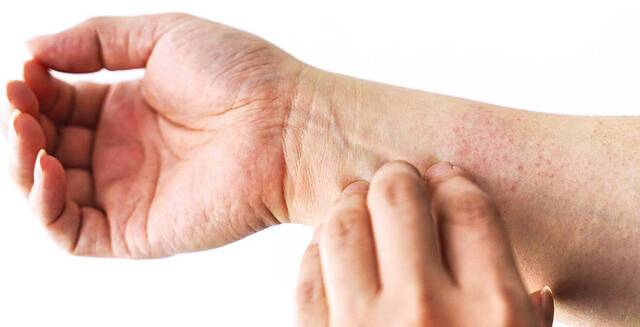 옴진드기는 0.3~0.4㎜ 정도밖에 안 되지만 엄청난 가려움증을 유발하는 게 특징이다. 게티이미지뱅크