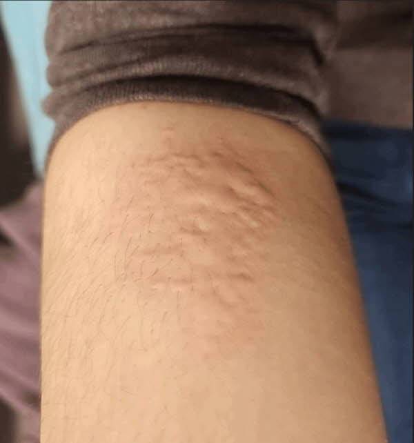 한랭 유발 유발 검사 후 A씨의 팔뚝./사진=큐레우스