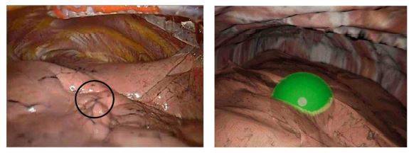 폐결절 위치를 나타낸 실제 흉강경 영상(왼쪽)과 시뮬레이션 영상 캡처. 고려대학교 안산병원