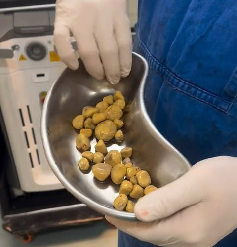 평소 탄산음료를 즐겨 먹은 브라질 남성의 방광에서 제거한 결석. 인스타그램 캡처