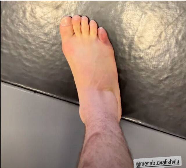 드발리시빌리의 오른 새끼발가락에 멍이 들어 있다. /인스타그램 'vato.gv' 캡처