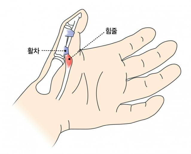 방아쇠 손가락(사진=강동경희대병원)