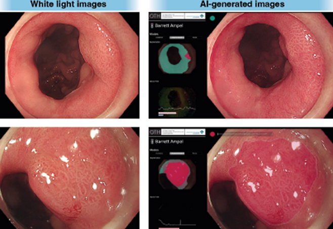 초기 바렛 신생물의 특성 분석한 검사 이미지. 왼쪽은 실제 병변을 촬영한 내시경 검사사진, 오른쪽은 신생물을 예측하여 인공지능이 생성한 이미지. 서울성모병원 제공
