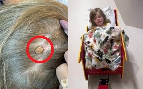 미국의 4세 소녀가 캠핑을 다녀온 뒤 진드기에 감염돼 전신 마비 증상을 겪었다. SNS 캡처