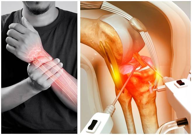 골다공증 환자가 한 해 130만명 가까이 발생하는 가운데, 치료제인 '골형성촉진제'의 급여 기준을 확대해야 한다는 목소리가 나왔다. 게티이미지뱅크