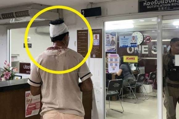 지난달 31일(현지시간) 밤 태국 파타야에서 스리랑카에서 온 50대 남성 관광객이 트랜스젠더 여성의 성별을 확인하겠다며 성기를 만졌다가 폭행을 당하는 일이 벌어졌다. 사진은 폭행 피해자인 남성이 피를 흘려 머리에 붕대를 감고 있는 모습. 사왕보리불 재단 제공