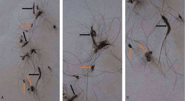 스크래치가 발생해 뭉쳐버린 A씨의 겨드랑이털(화살표)./사진=큐레우스