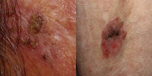 광선각화증, 보웬병. 서울대병원 제공