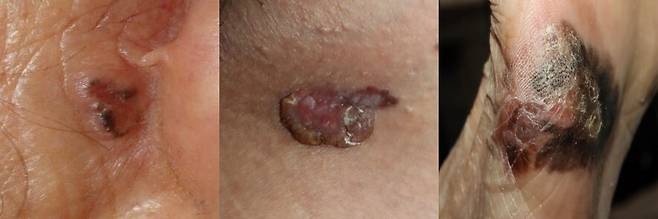 기저세포암, 편평세포암, 악성흑색종. 서울대병원 제공