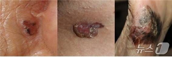 (왼쪽부터)기저세포암, 편평세포암, 악성흑색종(서울대병원 제공)