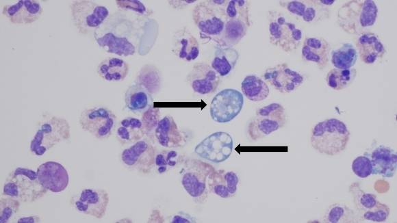 뇌척수액 내 ‘파울러자유아메바’(Naegleria fowleri)의 모습. 미국 질병통제예방센터(CDC) 캡처