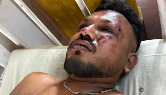 12일(현지시간) 인도 서부 구자라트주 아마다바드에 발생한 에어인디아 항공기 추락 사고의 유일한 생존자인 라메시 비스와시쿠마르(40). <출처=힌두스탄타임스 기사 갈무리>