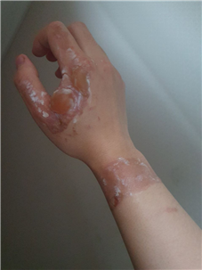 ▲고온‧고압의 스팀을 배관에 주입하다 2도 화상을 입은 한전KPS비정규직지회 조합원의 오른손 모습. ⓒ대책위