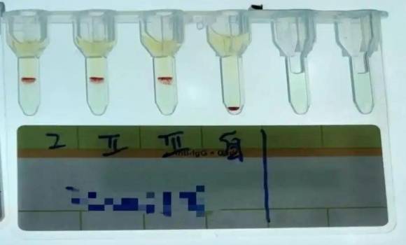 중국 윈난성에서 극히 드문 ‘p형’ 혈액형 보유자가 확인됐다. 사진은 p형 혈액형 표본. 지무뉴스 제공