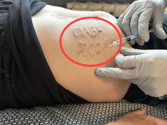 러시아에 포로로 잡혔던 우크라이나 군인의 몸에 남은 흉터. 사진=막심 투르케비치