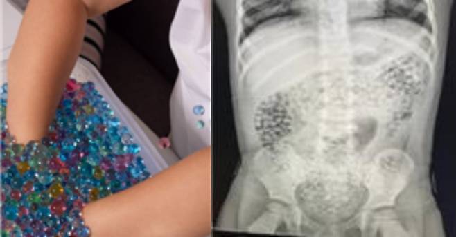 수경 원예용으로 사용되는 수정토를 촉감놀이용으로 잘못 사용하는 경우(왼쪽), 어린이 장 속에서 발견된 수정토 X-ray 사진. /한국소비자원, 미국 소비자제품안전위원회(CPSC)