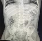 어린이 장 속에서 발견된 수정토(워터비즈) 엑스레이 사진. 미국 소비자제품안전위원회