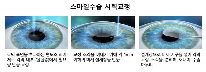 스마일수술 과정./사진=온누리스마일안과
