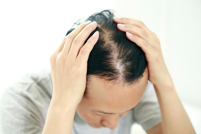 탈모
