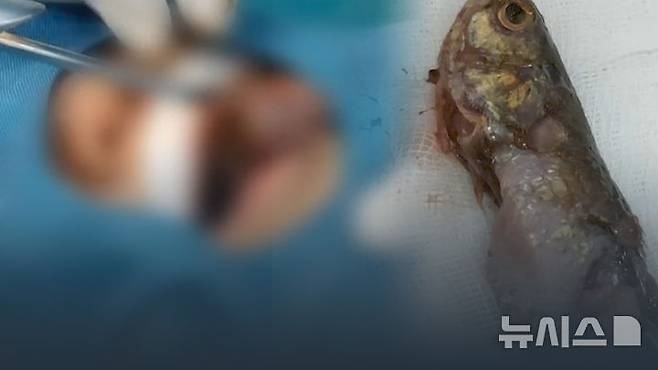 베트남에서 4살 남자아이가 살아 있는 민물고기를 목에 삼키는 사고가 발생해 긴급 수술을 받았다. 출처 : tuoitre *재판매 및 DB 금지