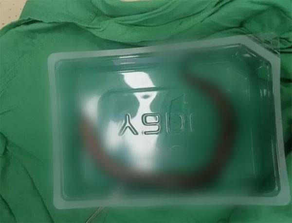 중국에서 한 남성의 뱃속에서 30cm 길이의 살아있는 장어가 발견됐다./사진=머스트쉐어뉴스