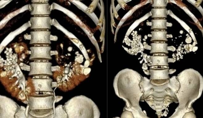 수백 개의 결석으로 가득 찬 베트남 남성의 신장 CT 스캔 영상/하노이 E병원