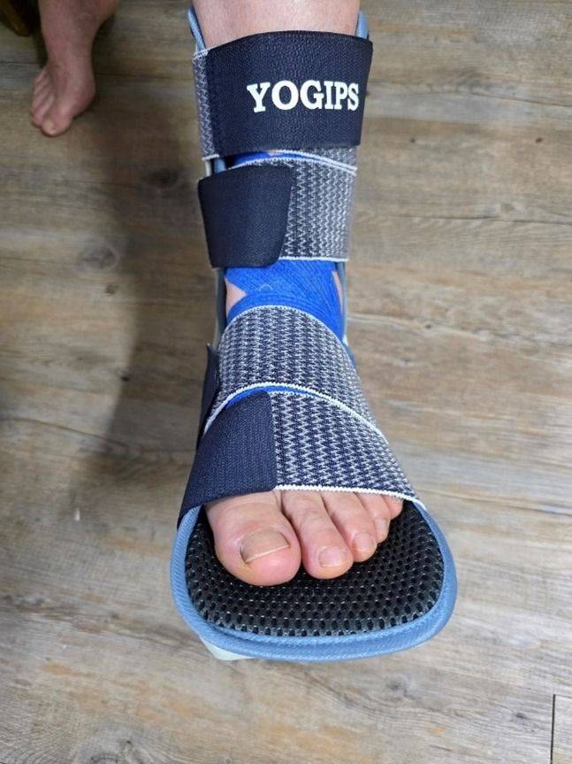 발등의 골절로 깁스를 한 아내의 발 모습 ⓒ