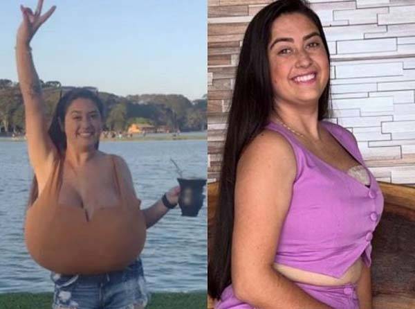 가슴이 급격하게 커져 결국 축소 수술을 받은 한 20대 여성의 사연이 전해졌다./사진=데일리메일