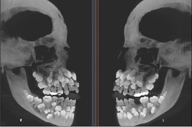 브라질 11세 소녀 입속에서 치아 81개가 발견돼 학계에 보고됐다./미국 치과교정·악안면외과학회지