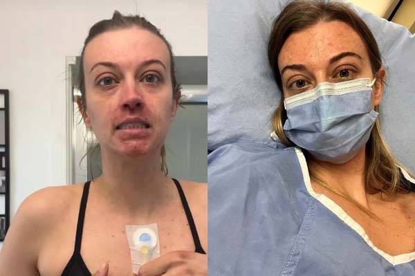 과거 과민성 대장 증후군을 진단받은 샤닌 페인(26)이 알고 보니 대장암 4기였던 사연이 전해졌다./사진=더 선