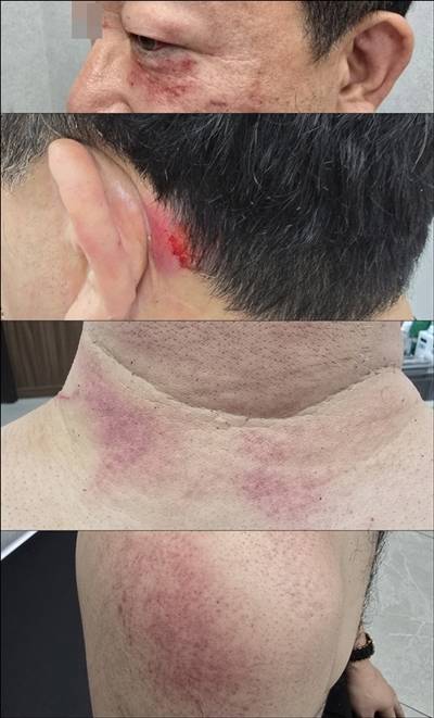 ▲박 기자는 몸 곳곳에 타박상을 입고 어금니가 깨지는 등 중상을 입고 즉시 병원으로 이송돼 현재까지 입원 치료를 받고 있다. 사진=박희범 기자 제공.