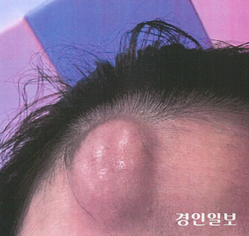 식당에서 넘어진 최모씨 이마에 생긴 혹. /최모씨 제공