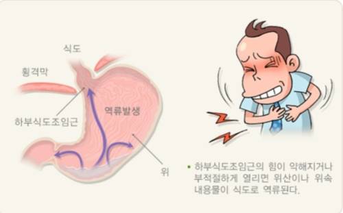 위와 식도 사이의 식도조임근이 약해지면 위산 역류가 발생할 수 있다. 질병관리청 국가건강정보포털