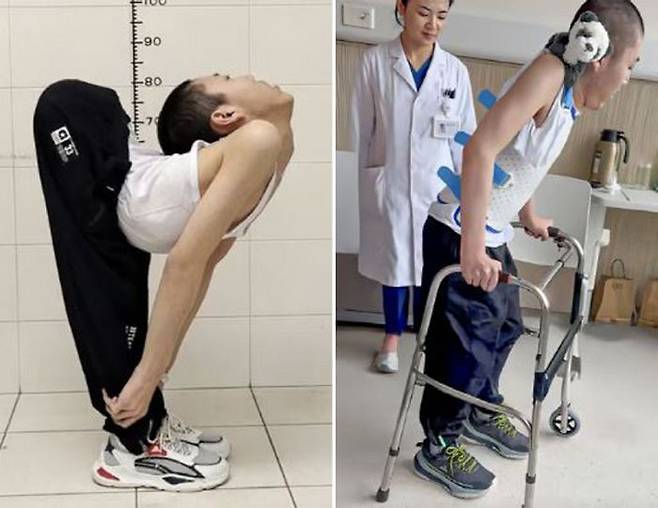 네 차례의 수술 사이사이 그는 하루 평균 6시간 재활 훈련을 이어갔다. 마지막 수술 두 달 뒤, 그는 드디어 생중계를 통해 직립 보행에 성공한 모습을 세상에 보여줬다. SCMP