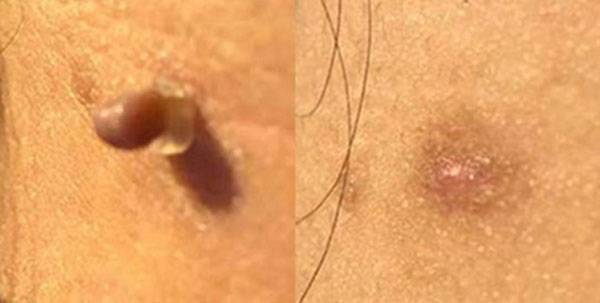 쥐젖·사마귀 제거용 고무 밴드는 간단해 보이지만, 괴사 과정에서 흉터나 색소침착이 생길 수 있다./사진=쿠팡 캡처