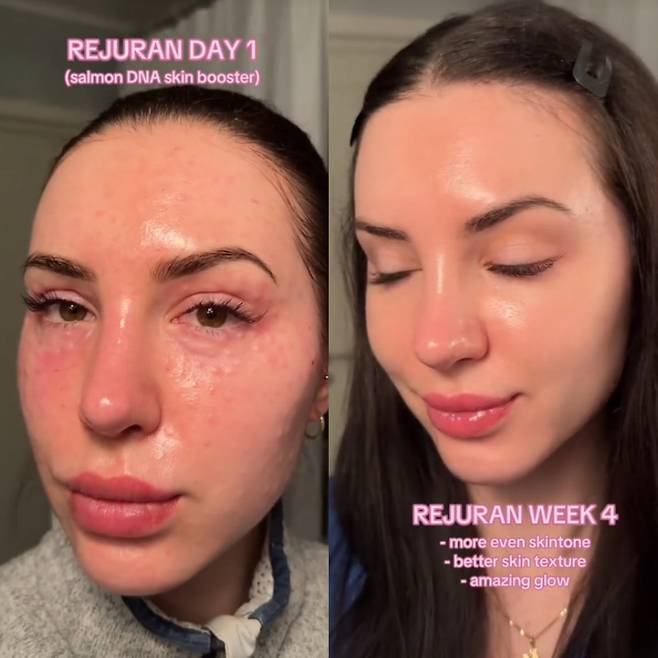 틱톡에 올라오는 외국인 관광객의 'K주사' 후기. 한국에서 리쥬란 주사 수술을 받고 난 뒤 피부 탄력이 좋아졌다는 내용이다. /틱톡